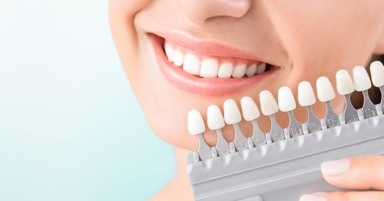 Professional teeth whitening